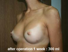 plastic-surgery-breast-augmentation 